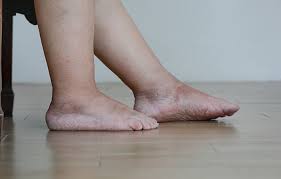 pieds gonflés
